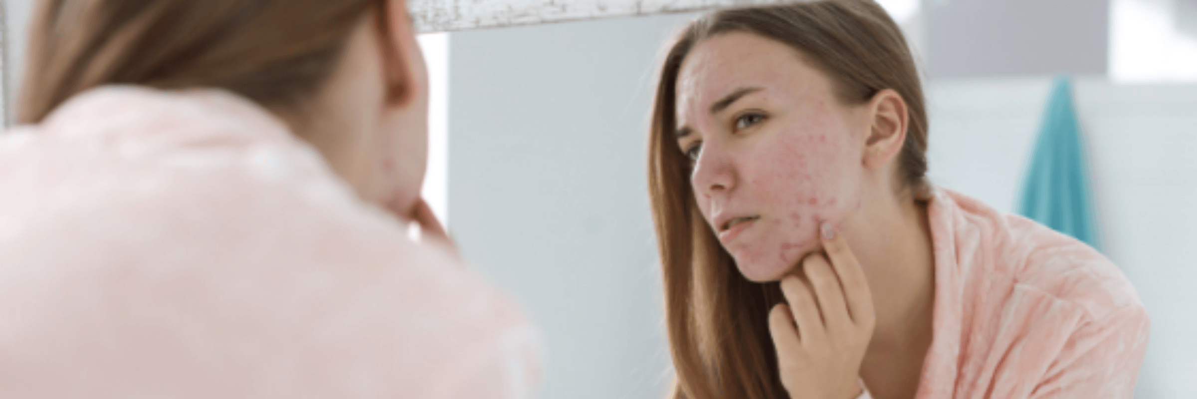 Combattre l'acné en 5 étapes faciles