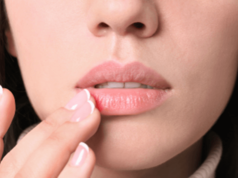 Es kribbelt auf der Lippe? Herpes-Virus erkennen | Herbano